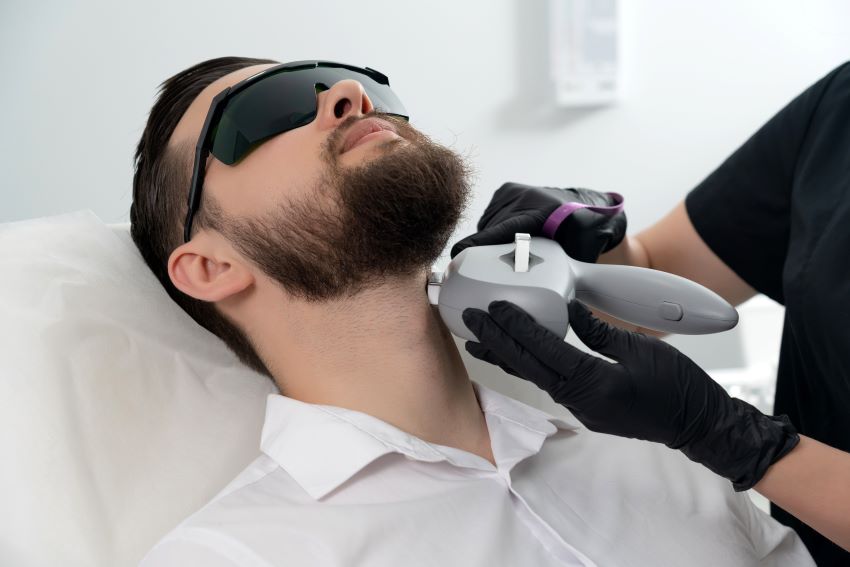 Depilación láser en la barba para hombre